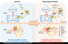 Two birds one stone strategy to treat both joint pain and cognitive impairment in rheumatoid arthritis 사진