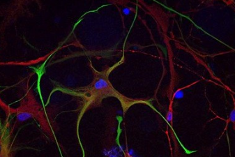 Development of an astrocytic scar model in brain using patient-derived glioblastomaorganoids